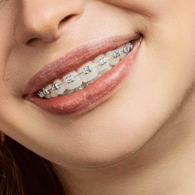 How to Keep Clear Braces Bands From Turning Yellow